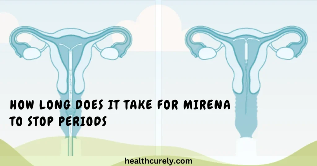 How Long Does It Take for Mirena to Stop Periods Naturally